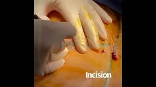 Breast Augmentation Surgery by Dr. David L. Cangello