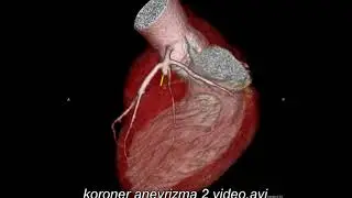 Koroner anevrizma 1