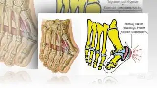 valgus pro отзывы

  - Valgus Pro Избавит от косточки