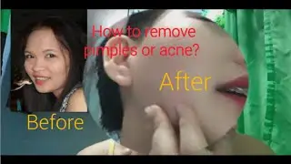 How to remove pimples or acne in just 1 month?  Gandang Venus | Lyn Venus-Villamin