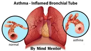 Understanding Asthma || Mild, Moderate, and Severe || Symptoms, Causes, Diagnosis and Treatment.