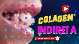 Colagem Indireta de Bráquetes Ortodônticos: Procedimentos e Melhores Práticas