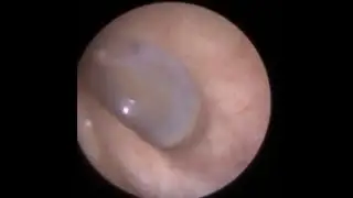 Endoscopic removal of foreign body in ear
