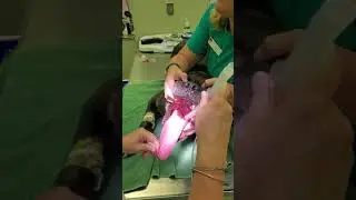 Passing an endotracheal tube