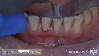 Удаление зубных камней ультразвуком (Acteon 001 4K B) - Апокин А.Д.