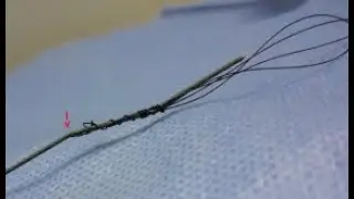 Homemade Nylon Basket Adapted For The Rigid Ureteroscope
