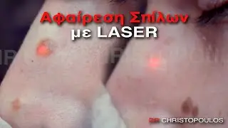 Αφαίρεση σπίλων με laser στη μύτη - Πλαστικός Χειρουργός