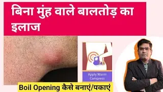बालतोड (Boil) को पकाने के उपाय | बिना मुंह वाले Boil का इलाज..