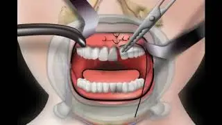 Šav gingivalne papile