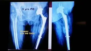 Periprosthetic fracture hip