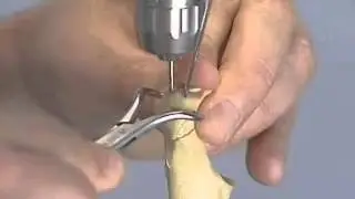 tention band wiring of olecranon #
