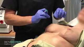Dr. Benjamin Brown, Plastic Surgeon - Breast Reduction/Lift - Nipple Delay