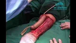 Reconstrucción pene/ Penis reconstruction