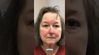We love patient before and after photos! Watch the full video on our channel! #agingbackwards