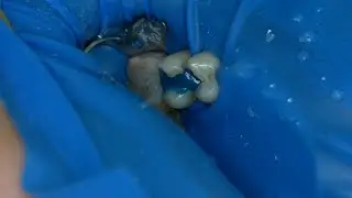 Кариес 14 15 EvoCeram OptiBond FL Sanctuary (прямой эфир)