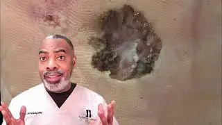 Skin Cancer of the Foot