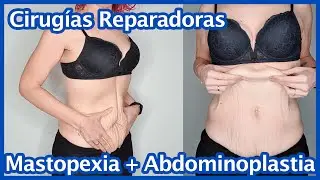 Cirugías Reparadoras Post Cirugía Bariátrica: Toda la Información que me Dio mi Cirujano