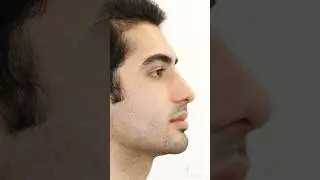 Incredible Male Rhinoplasty Results in 6 weeks! #shorts #rhinoplasty