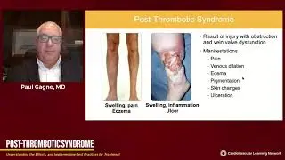 Post-Thrombotic Syndrome: Understanding the Effects and Implementing Best Practices for Treatment