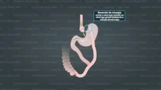 Reversão da Cirugia Bariátrica