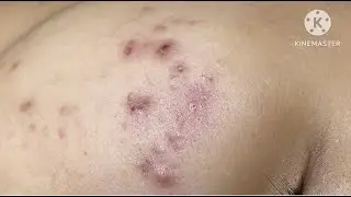 Inflammatory acne on cheeks 