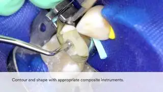 RelyX Fiber Post 3D Posterior Unicem2
