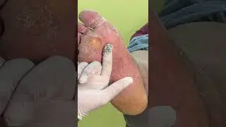 Exfoliation of the Feet Is Important