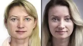 Подтяжка лица  Липофиллинг  Доктор Гурьянов