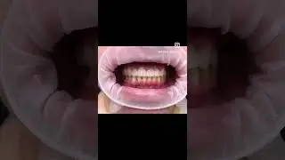 Новая улыбка. Коронки диоксид циркония