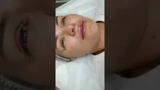 Меди-Лайт. Коррекция губ.