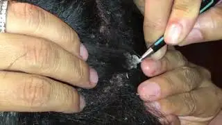 Dandruff Flakes! Pt. 1 of 4