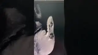 Опухоль пальца