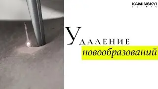 Удаление новообразований CO2 лазером 