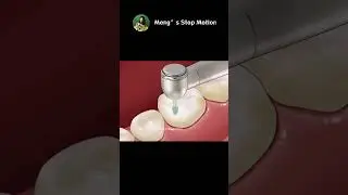 Dental Caries Damages Tooth! AMAZING Dental ASMR Animation! | Meng's Stop Motion