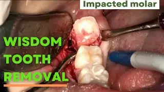 🥶🥶wisdom tooth removal | third molar extraction | last tooth | Your Dentist #wisdomteeth #extraction