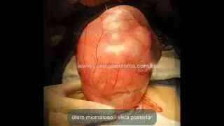 Miomectomia 3 - Mioma Gigante