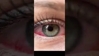 Computer eye syndrome 😔