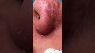 Pimple Removal Compilations