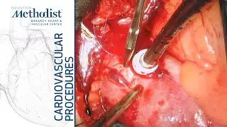 Central Cannulation for Acute Type A Aortic Dissection (Ramchandani, MD; Al Abri, MD; Zubair, MD)