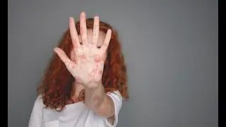 Measles signs and symptoms
