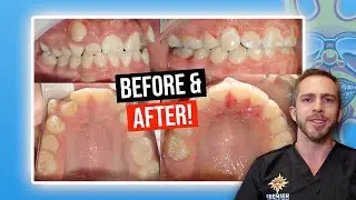 BRACES BEFORE & AFTER: Crowding with Missing Teeth