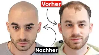 Marcels Ergebnis - Haarpigmentierung | Erfahrungen und Ergebnisse
