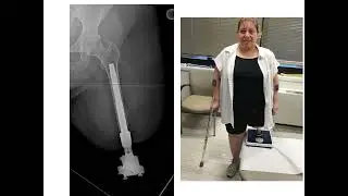 Dr. Rozbruch discusses Osseointegration of femur