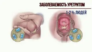 Уретрит лечение от уролога пошагово.