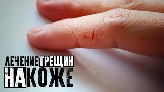 Лечение трещин на коже