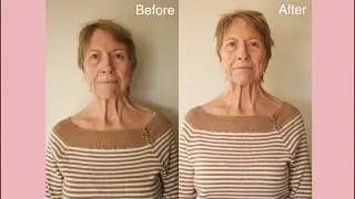 PlasmaPen Facial Treatment - Promotional Video | The Facial Architect | Alannah Jade