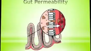 Leaky Gut // WellBeingGPS.com