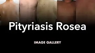 Pityriasis Rosea: Image Gallery