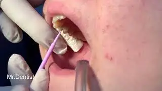 Composite Tooth Filling  !!!!