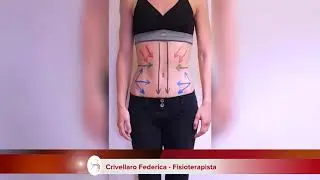 Aumento della lordosi lombare in caso di Diastasi Addominale